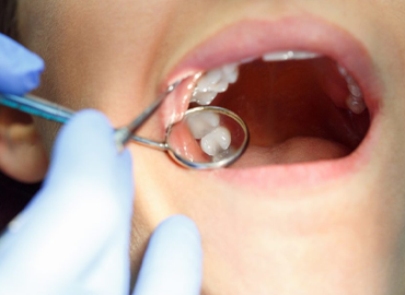 جراحی دندانهای عقل و نهفته