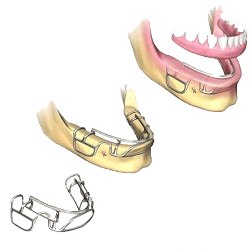 ایمپلنت‌های ساب پریواستیل(Subperiosteal Implants):