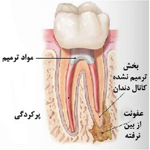 کشیدن دندان (Dental Extraction)