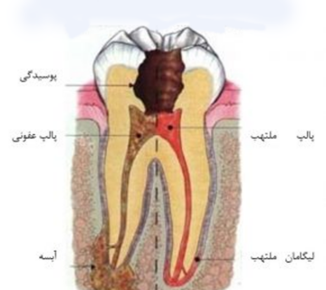 کف بندی دندان