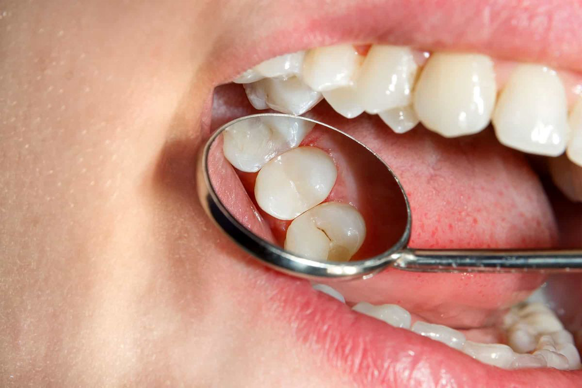 مراقبت-های-ترمیم-دندان