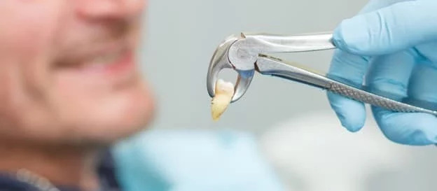 مراقبت بعد از كشيدن دندان