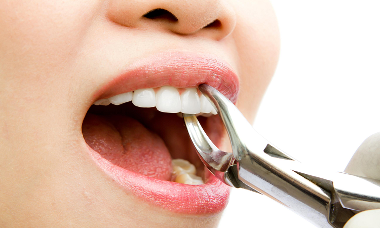 کشیدن دندان چگونه انجام می‌شود؟ 