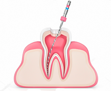 مراقبت درمان ریشه دندان