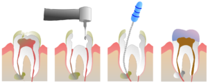 مراقبت درمان ریشه دندان