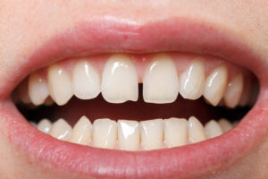 بستن-فاصله-دندان