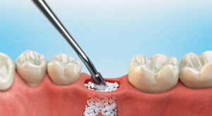 پیوند-استخوان-قبل-از-ایمپلنت-دندان