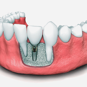 پیوند-استخوان-قبل-از-ایمپلنت-دندان
